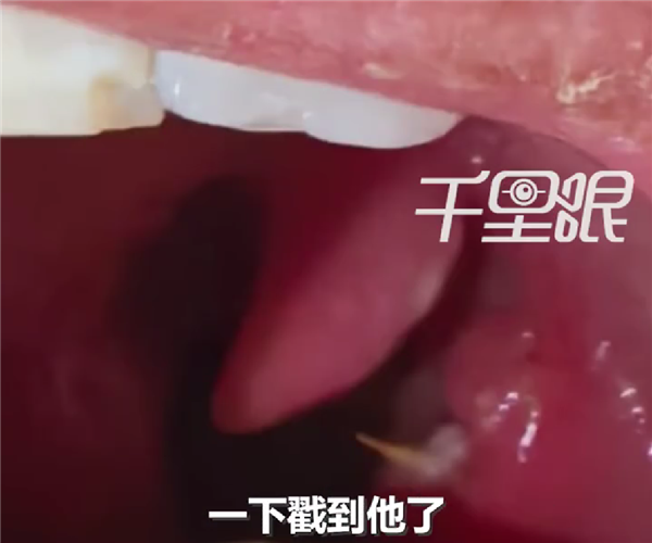 男子竹签卡喉误以为刀片嗓：吃8天药越吃越严重